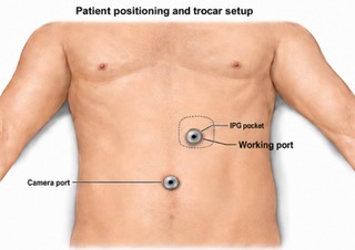 Patient positioning and trocar setup showing camera port, working port, and IPG pocket