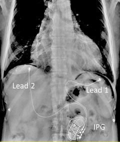X-ray illustration of VisONE implant with leads
